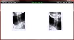 Two virtual radiographs of the patient's Cervical Spine showing the differences in projection between posterior (L) and anterior (R) obliques