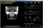parietoacanthial_lecture_demo