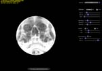 Occipito-Mental (OM) projection of sinuses