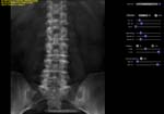 Anterio-Posterior (AP) lumbar spine projection