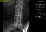 Right Posterior Oblique (RPO) lumbar spine projection