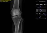 Left knee AP projection (slight internal rotation required)